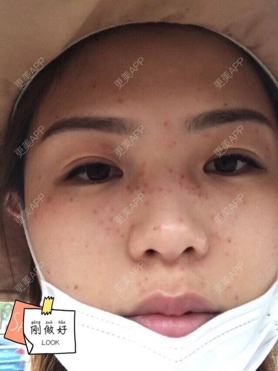 更美 - 更美用户DrgBVKI7yN的皮秒激光经验 | 皮秒激光 | 上海