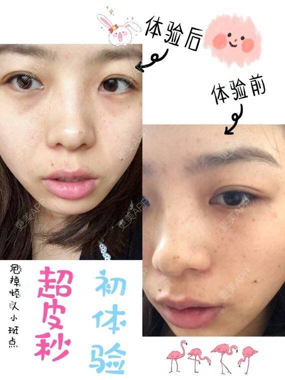 更美 - 更美用户DrgBVKI7yN的皮秒激光经验 | 皮秒激光 | 上海