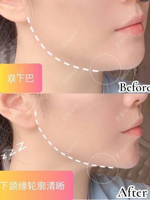 更美 - 更美用户BcePdLFXg6的射频溶脂经验 | 射频溶脂 | 上海