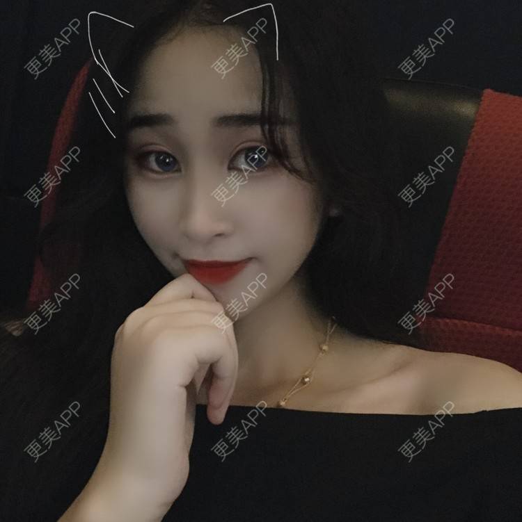 更美 - 摇啊摇啊摇X的全切双眼皮经验 | 广州 | 视频日记 | 全切双眼皮