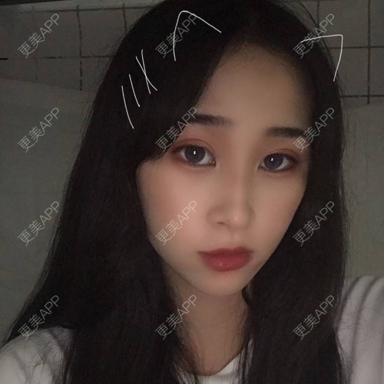 更美 - 摇啊摇啊摇X的全切双眼皮经验 | 广州 | 视频日记 | 全切双眼皮