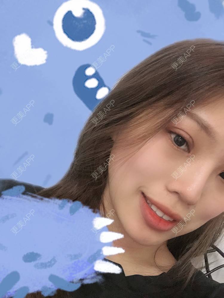 更美 - 二闪亮晶晶的全切双眼皮经验 | 广州 | 全切双眼皮