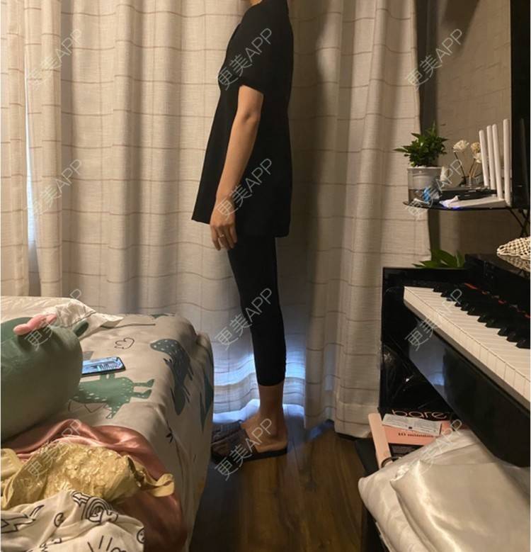 更美 - 玉琼#的自体脂肪丰臀经验 | 自体脂肪身体塑形 | 自体脂肪丰臀 | 上海