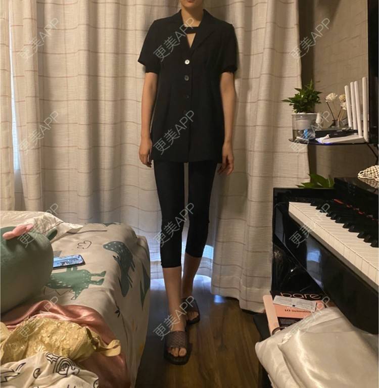 更美 - 玉琼#的自体脂肪丰臀经验 | 自体脂肪身体塑形 | 自体脂肪丰臀 | 上海