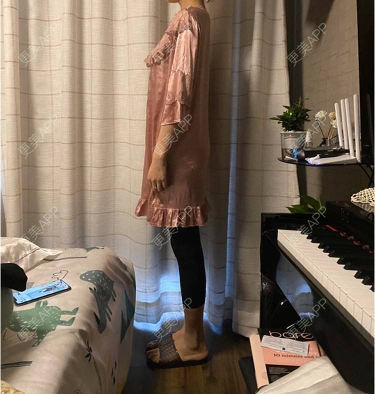 更美 - 玉琼#的自体脂肪丰臀经验 | 自体脂肪丰臀 | 上海 | 自体脂肪身体塑形