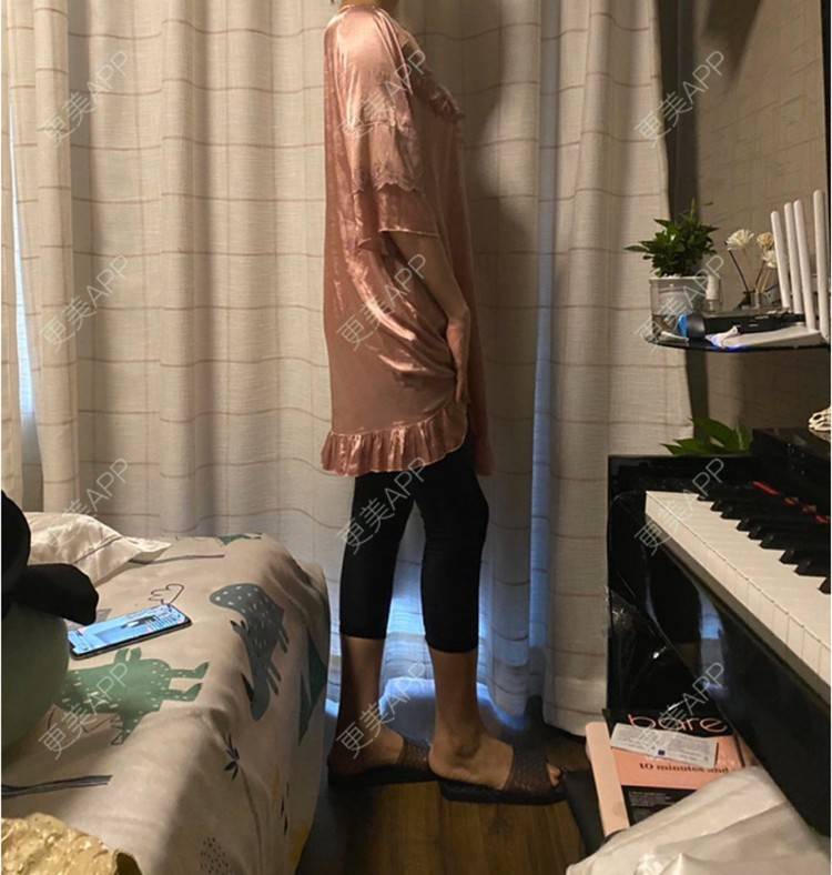 更美 - 玉琼#的自体脂肪丰臀经验 | 自体脂肪丰臀 | 上海 | 自体脂肪身体塑形