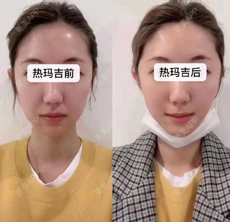 热玛吉,热玛吉前后对比照_更美用户pw6tpcdfdt热玛吉前后对比照_更美