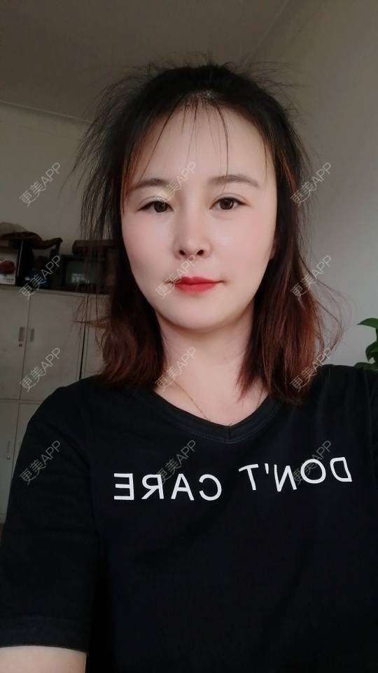 更美 - 爱折腾的小姐姐的射频去眼袋经验 | 西安 | 射频去眼袋