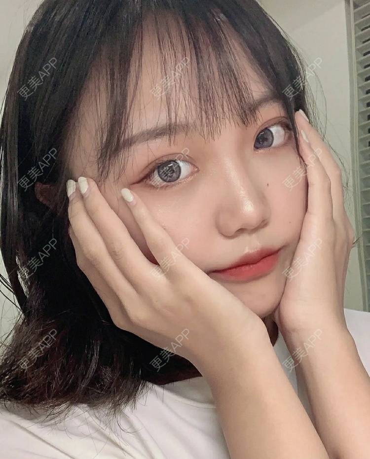 更美 - 更美用户AmdwvwVNC9的切眉经验 | 切眉