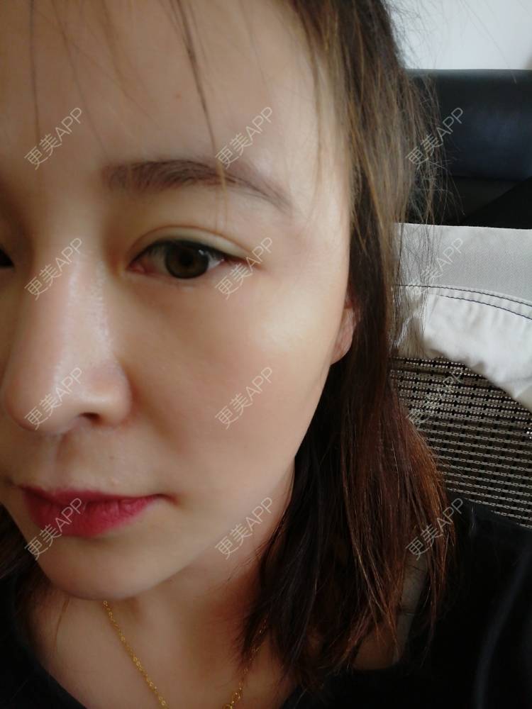 更美 - 爱折腾的小姐姐的射频去眼袋经验 | 西安 | 射频去眼袋