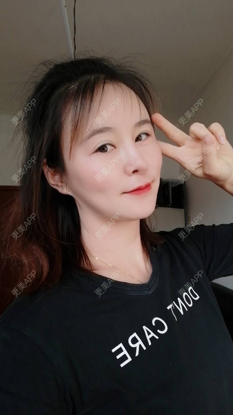 更美 - 爱折腾的小姐姐的射频去眼袋经验 | 西安 | 射频去眼袋