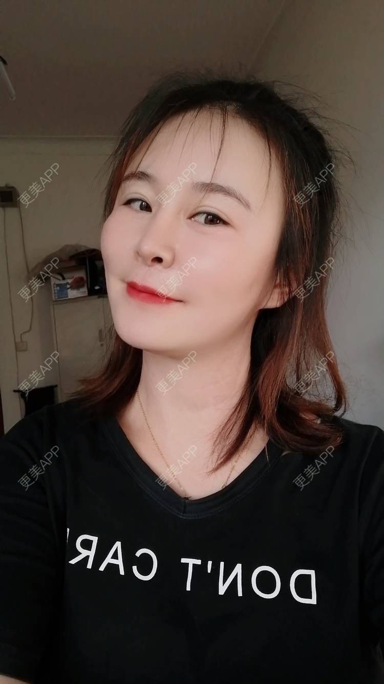 更美 - 爱折腾的小姐姐的射频去眼袋经验 | 西安 | 射频去眼袋