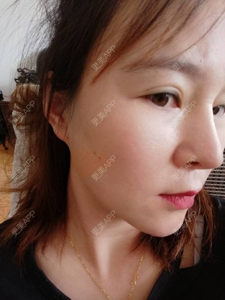 更美 - 爱折腾的小姐姐的射频去眼袋经验 | 西安 | 射频去眼袋