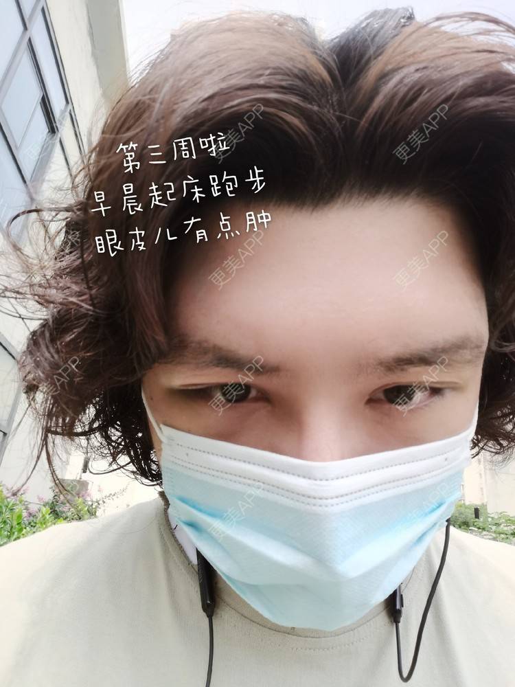更美 - 更美用户1IFu7ZHnJm的经验 | 垫眉弓 | 玻尿酸眉弓 | 硅胶垫眉弓 | 自体脂肪垫眉弓 | 膨体垫眉弓