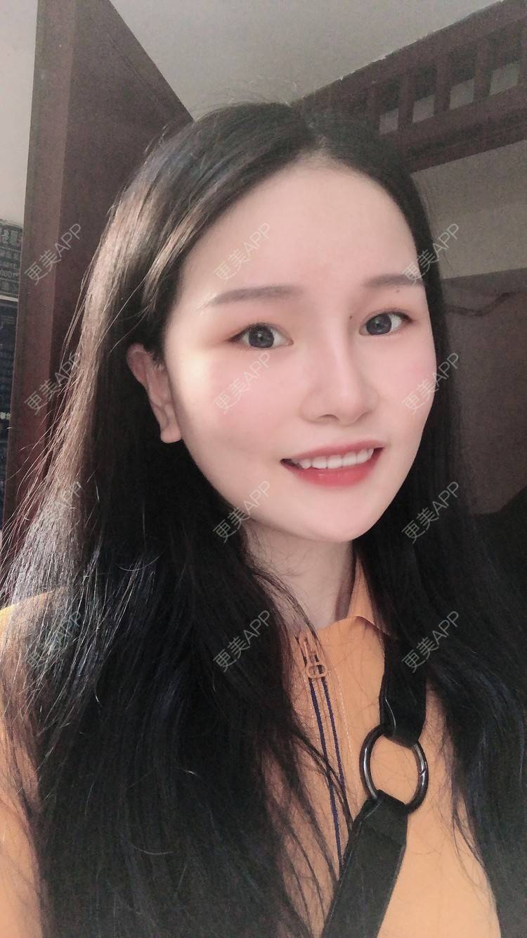 更美 - 更美用户1hOuWDVG0V的下颌角经验 | 成都 | 下颌角