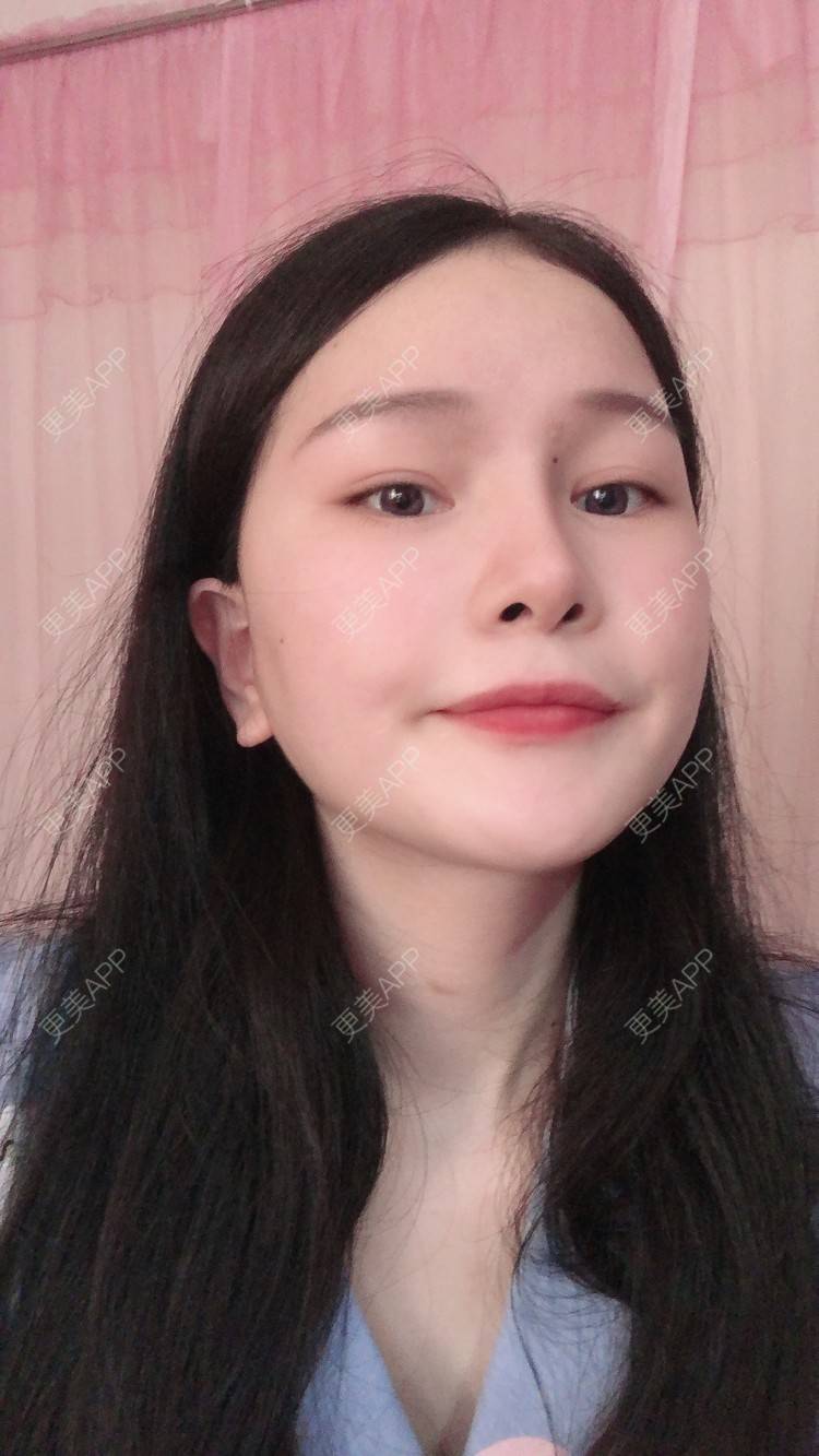 更美 - 更美用户1hOuWDVG0V的下颌角经验 | 成都 | 下颌角