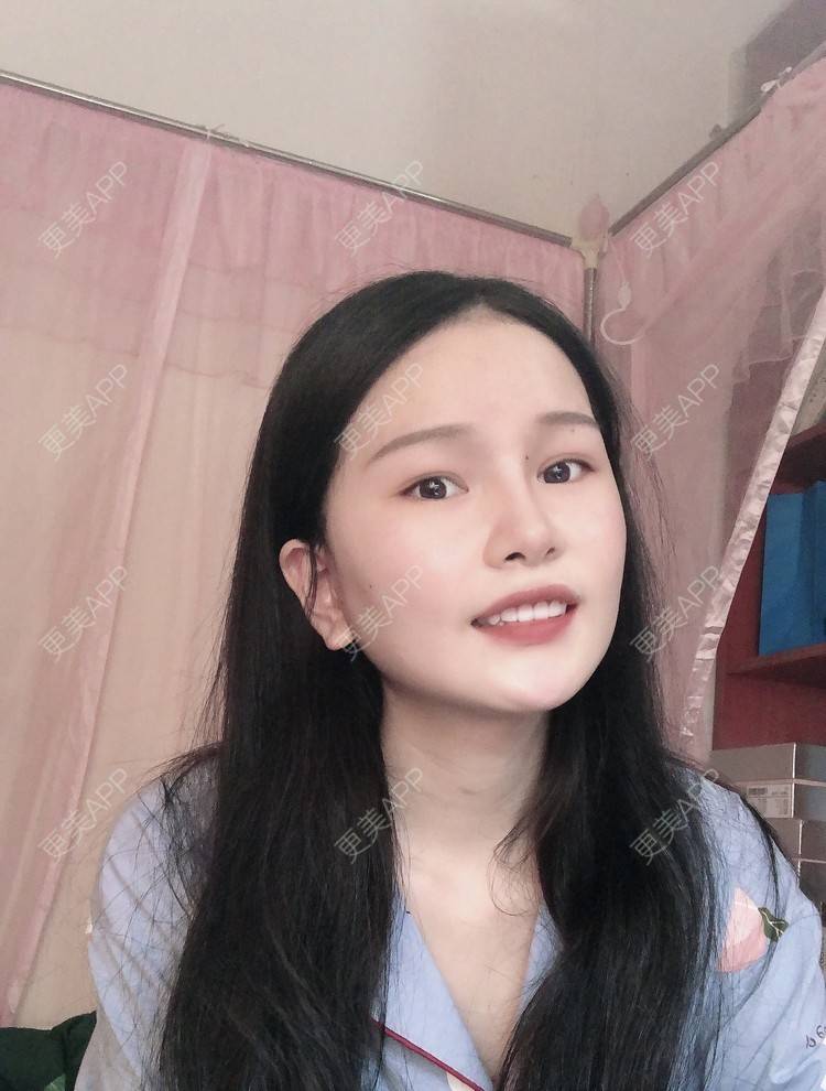 更美 - 更美用户1hOuWDVG0V的下颌角经验 | 成都 | 下颌角