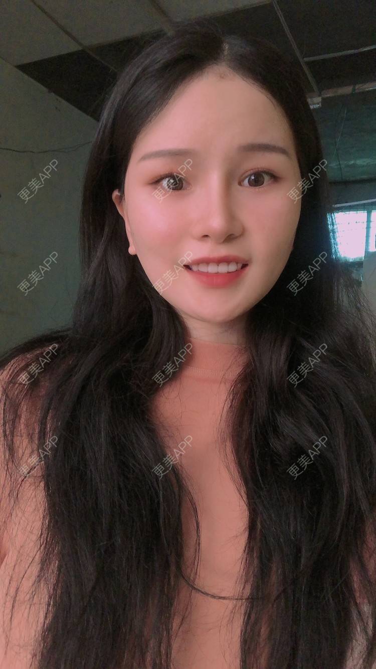 更美 - 更美用户1hOuWDVG0V的下颌角经验 | 成都 | 下颌角