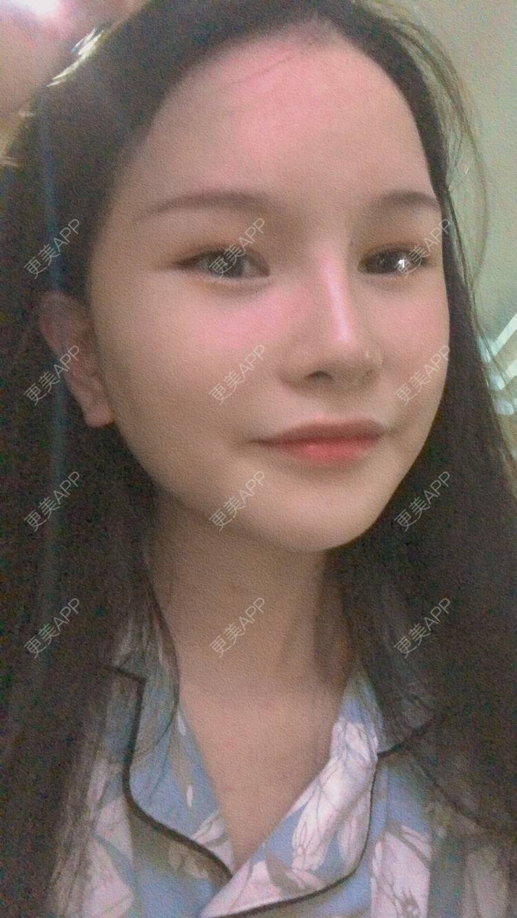 更美 - 更美用户1hOuWDVG0V的下颌角经验 | 成都 | 下颌角