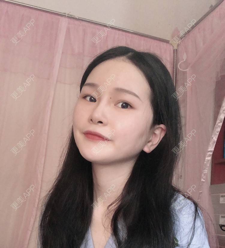 更美 - 更美用户1hOuWDVG0V的下颌角经验 | 成都 | 下颌角