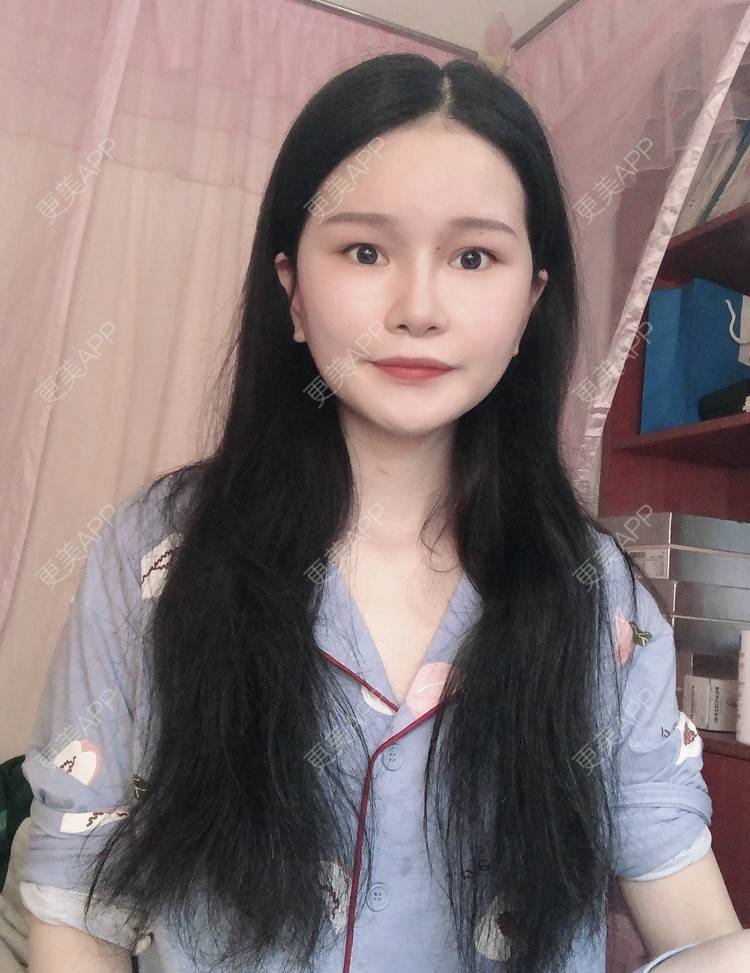 更美 - 更美用户1hOuWDVG0V的下颌角经验 | 成都 | 下颌角