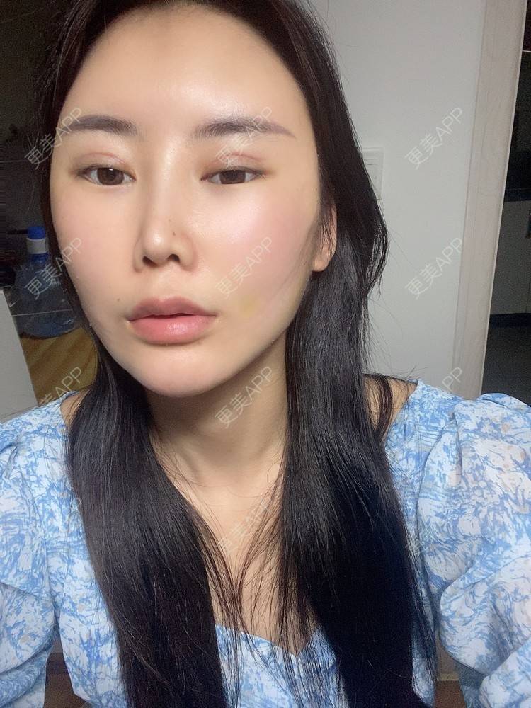 更美 - 明眸善睐666的玻尿酸唇部经验 | 玻尿酸唇部 | 成都 | 玻尿酸