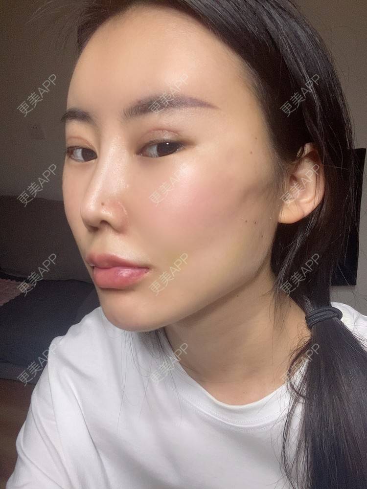 更美 - 明眸善睐666的玻尿酸唇部经验 | 玻尿酸唇部 | 成都 | 玻尿酸
