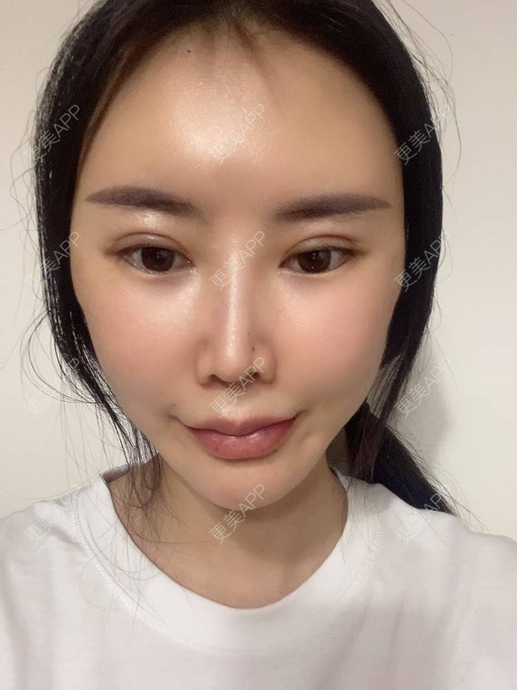 更美 - 明眸善睐666的玻尿酸唇部经验 | 玻尿酸唇部 | 成都 | 玻尿酸