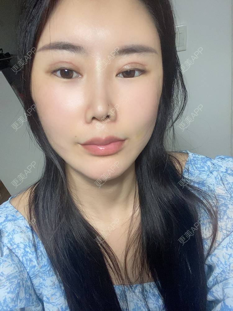 更美 - 明眸善睐666的玻尿酸唇部经验 | 玻尿酸唇部 | 成都 | 玻尿酸