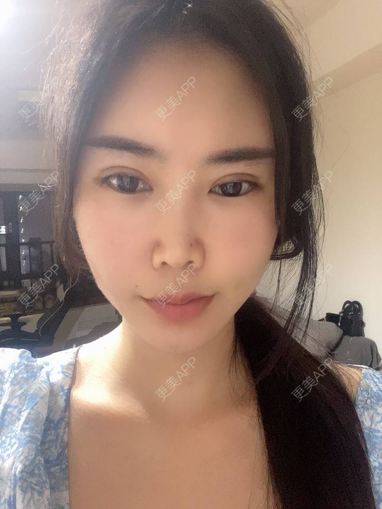 更美 - 明眸善睐666的玻尿酸唇部经验 | 玻尿酸唇部 | 成都 | 玻尿酸