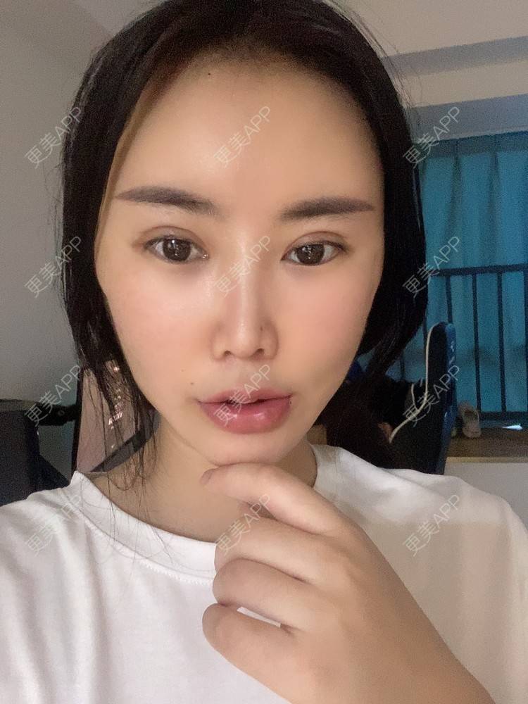 更美 - 明眸善睐666的玻尿酸唇部经验 | 玻尿酸唇部 | 成都 | 玻尿酸