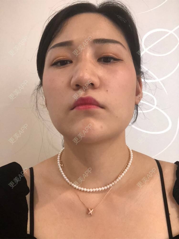 更美 - 阿发4.1的注射塑形腿部经验 | 注射塑形腿部 | 上海