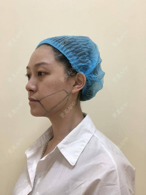 更美 - 贝勒爷贝贝的全脸整形套餐经验 | V脸套餐 | 全脸整形套餐 | 北京