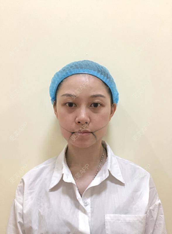 更美 - 贝勒爷贝贝的全脸整形套餐经验 | V脸套餐 | 全脸整形套餐 | 北京