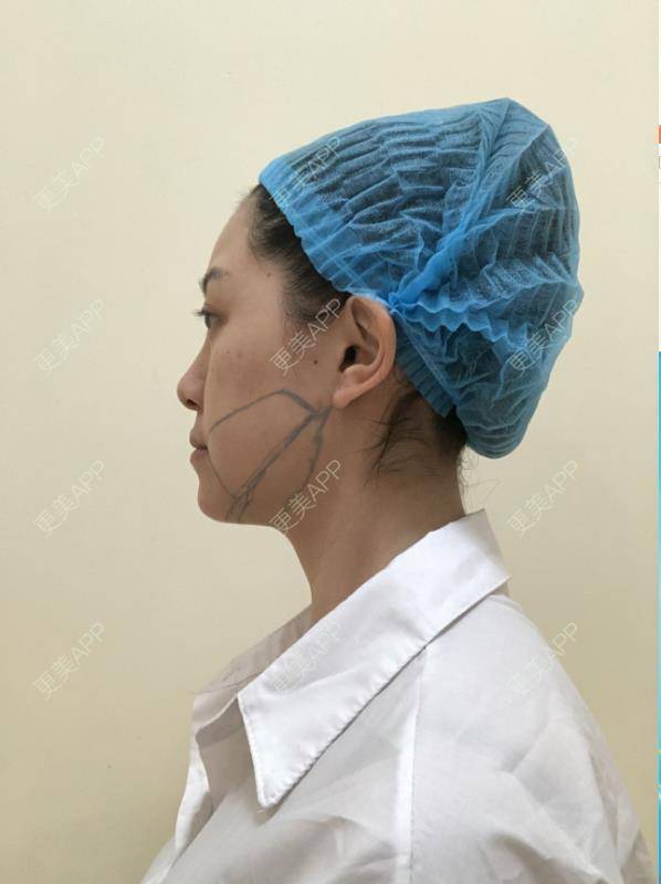 更美 - 贝勒爷贝贝的全脸整形套餐经验 | V脸套餐 | 全脸整形套餐 | 北京