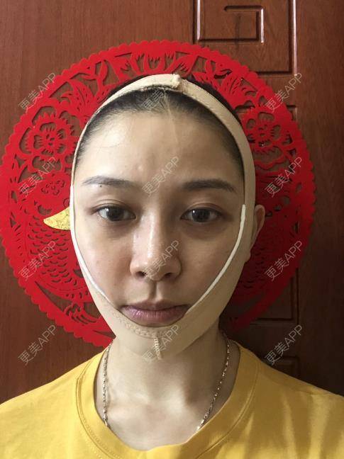 更美 - 贝勒爷贝贝的全脸整形套餐经验 | 全脸整形套餐 | V脸套餐 | 北京