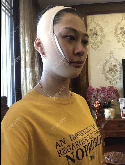 更美 - 贝勒爷贝贝的全脸整形套餐经验 | 全脸整形套餐 | V脸套餐 | 北京