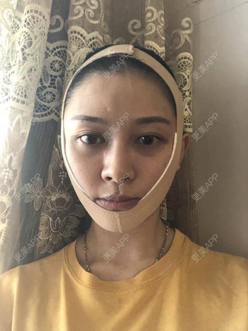 更美 - 贝勒爷贝贝的全脸整形套餐经验 | 全脸整形套餐 | V脸套餐 | 北京