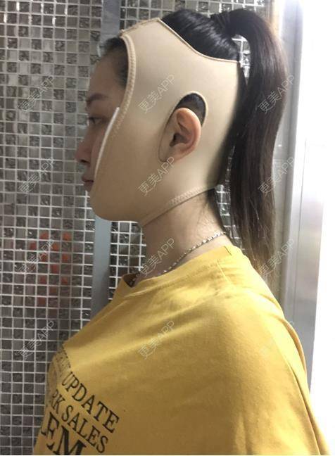 更美 - 贝勒爷贝贝的全脸整形套餐经验 | 全脸整形套餐 | V脸套餐 | 北京