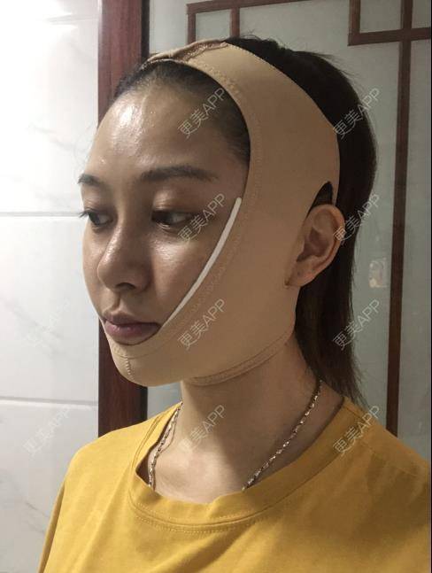 更美 - 贝勒爷贝贝的全脸整形套餐经验 | 全脸整形套餐 | V脸套餐 | 北京