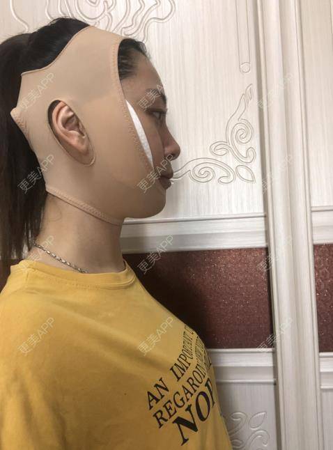 更美 - 贝勒爷贝贝的全脸整形套餐经验 | 全脸整形套餐 | V脸套餐 | 北京