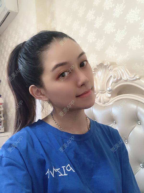 更美 - 贝勒爷贝贝的全脸整形套餐经验 | 全脸整形套餐 | V脸套餐 | 北京