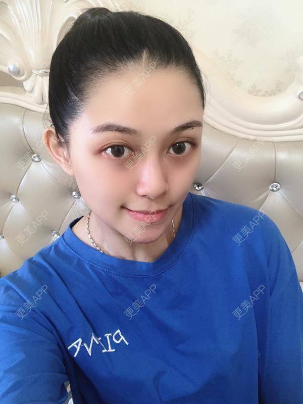 更美 - 贝勒爷贝贝的全脸整形套餐经验 | 全脸整形套餐 | V脸套餐 | 北京