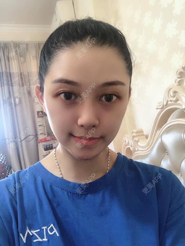 更美 - 贝勒爷贝贝的全脸整形套餐经验 | 全脸整形套餐 | V脸套餐 | 北京