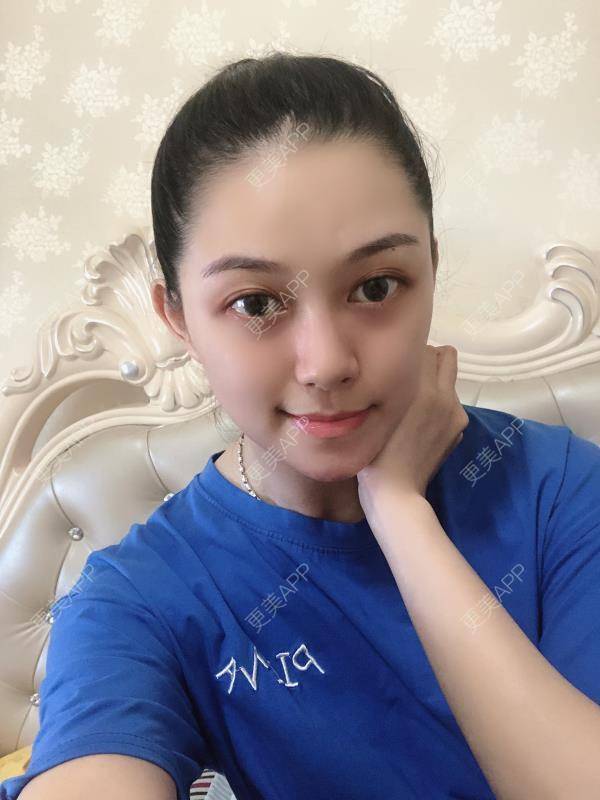 更美 - 贝勒爷贝贝的全脸整形套餐经验 | 全脸整形套餐 | V脸套餐 | 北京