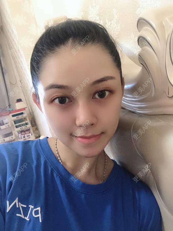 更美 - 贝勒爷贝贝的全脸整形套餐经验 | 全脸整形套餐 | V脸套餐 | 北京