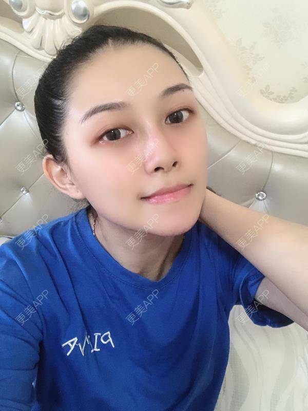 更美 - 贝勒爷贝贝的全脸整形套餐经验 | 全脸整形套餐 | V脸套餐 | 北京