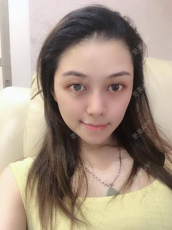 更美 - 贝勒爷贝贝的全脸整形套餐经验 | 全脸整形套餐 | V脸套餐 | 北京