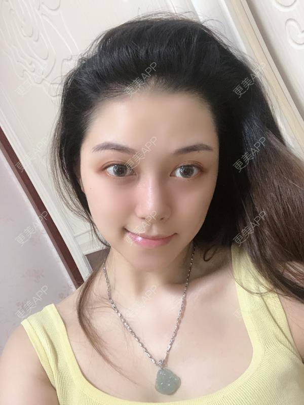 更美 - 贝勒爷贝贝的全脸整形套餐经验 | 全脸整形套餐 | V脸套餐 | 北京