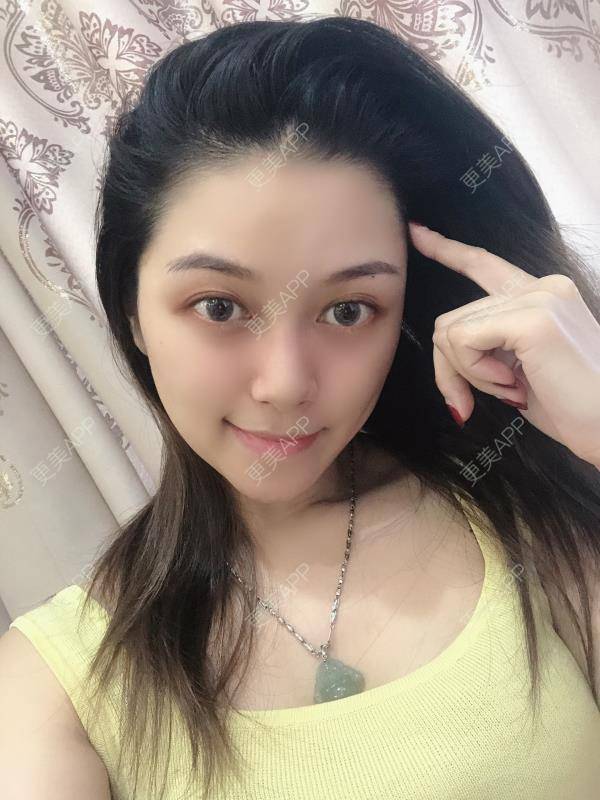 更美 - 贝勒爷贝贝的全脸整形套餐经验 | 全脸整形套餐 | V脸套餐 | 北京